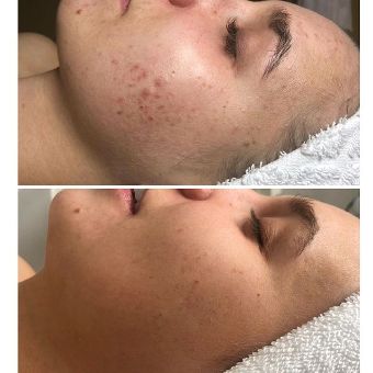 MICRONEEDLING